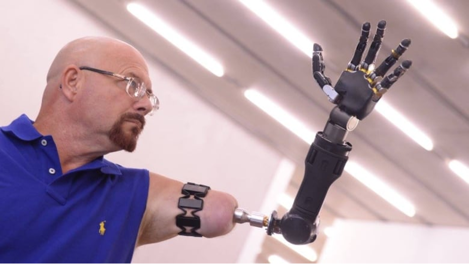 Johnny Matheny's bionic arm